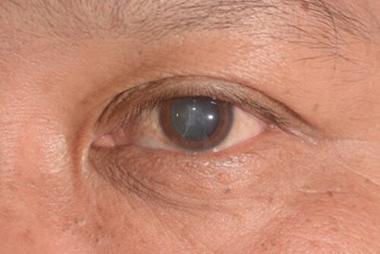 Glaucoma Treatment symptoms melbourne