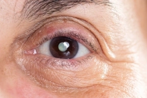 What Are The 3 Types Of Cataracts symptoms